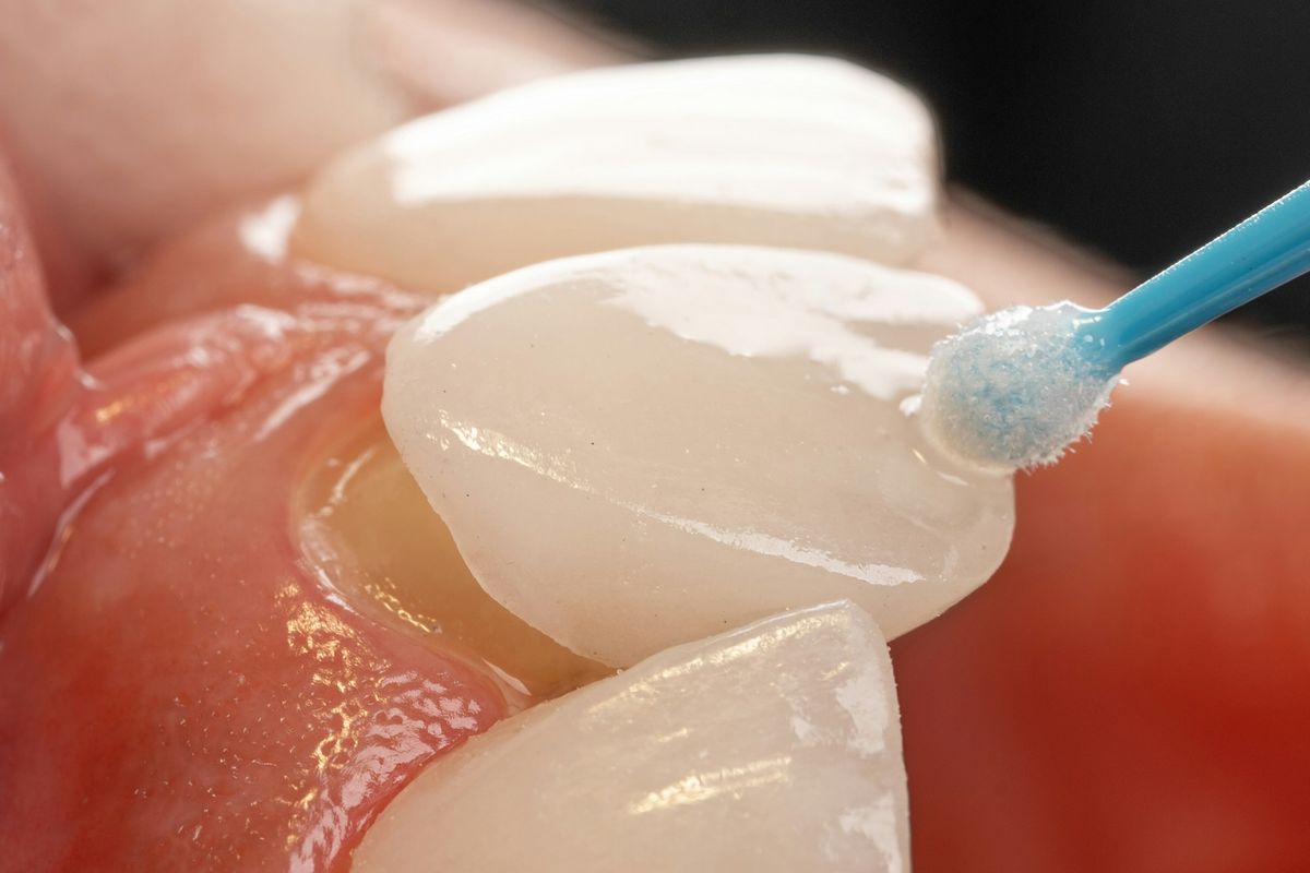 Pose facette dentaire