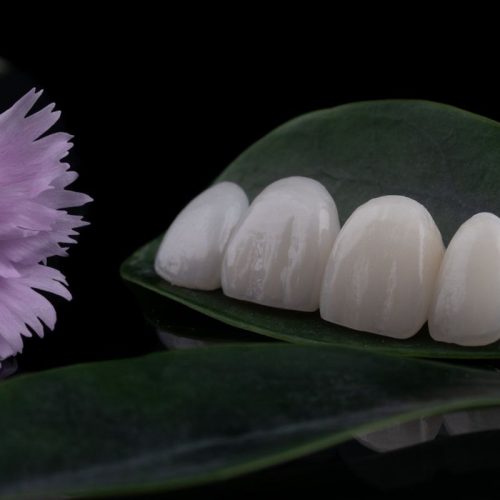 facette-dentaire-bucarest