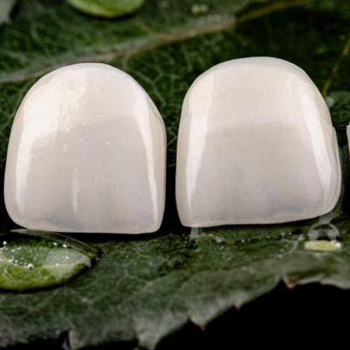 facette-dentaire-dental-romania-bucarest