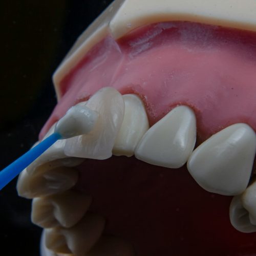 facette-dentaire-dental-romania