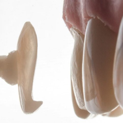 facette-dentaire-roumanie