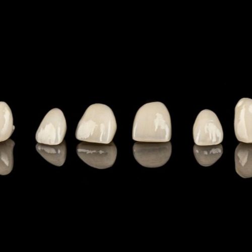 facettes-dentaires-roumanie