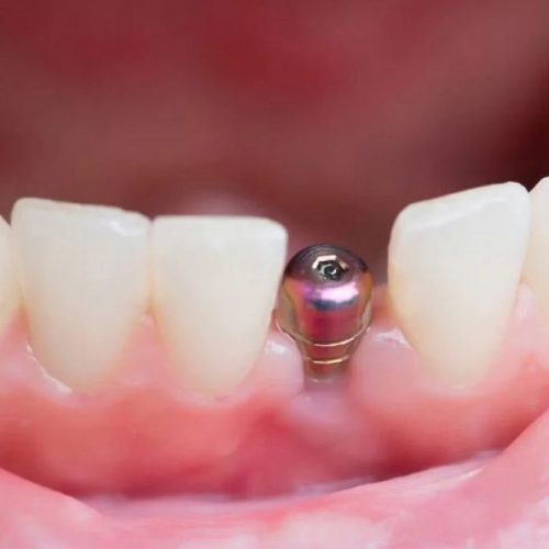 implant-dentaire-bucarest