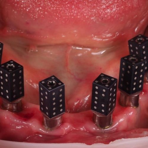 pose-implant-dentaire